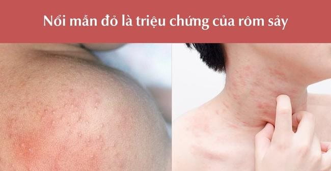 Mẩn đỏ do rôm sảy