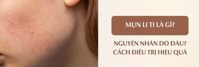 Mụn li ti trên mặt