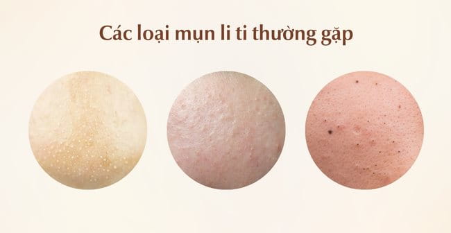 Các loại mụn li ti trên mặt thường gặp