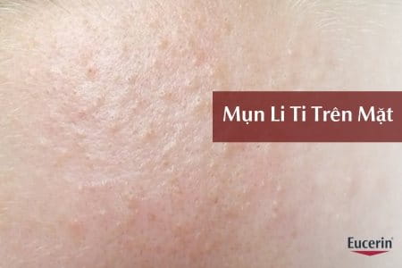 Mụn li ti trên mặt