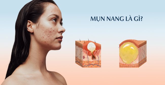 Mụn nang là gì?