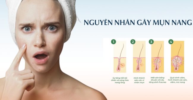 Nguyên nhân gây mụn nang