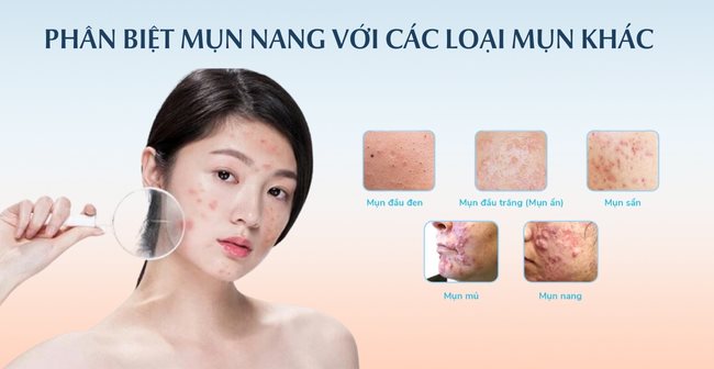 Phân biệt mụn nang với các loại mụn khác