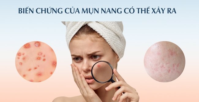 Biến chứng của mụn nang có thể xảy ra