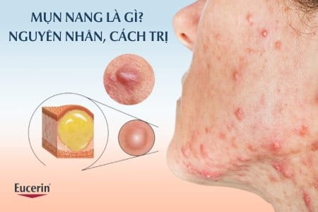 Mụn nang là gì