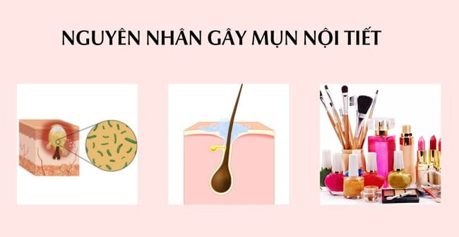 Nguyên nhân gây mụn nội tiết