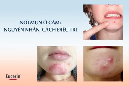 Mọc mụn ở cằm