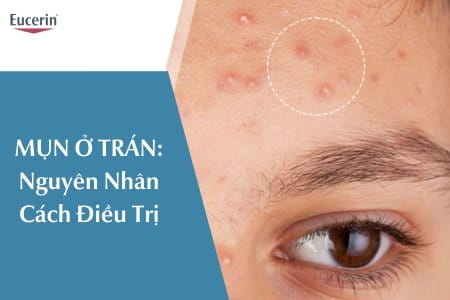 Mụn ở trán: nguyên nhân, cách điều trị