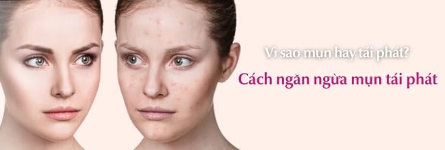 Cách ngăn ngừa mụn tái phát hiệu quả