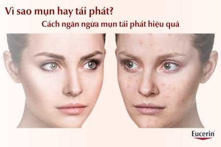 Vì sao mụn tái phát, cách ngăn ngừa mụn quay trở lại