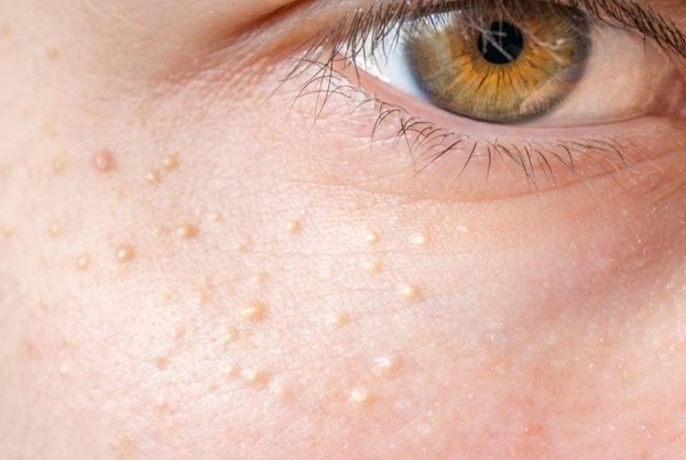 Mụn Thịt Là Gì? Nguyên nhân, Dấu Hiệu, Cách Trị Hiệu Quả