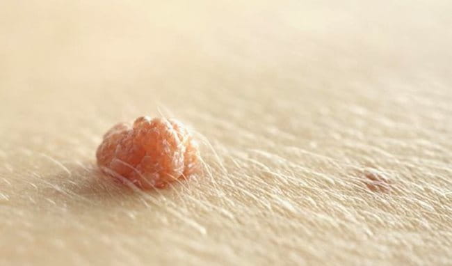 mụn thịt có tự hết không