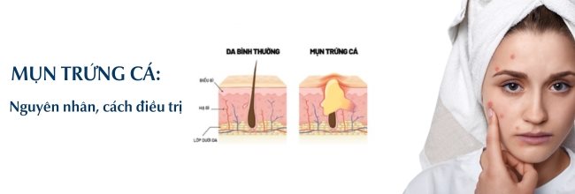 Mụn trứng cá: Nguyên nhân, cách điều trị