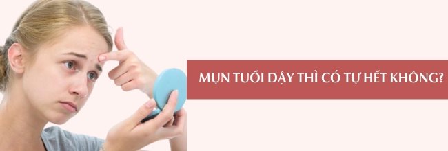 Mụn tuổi dậy thì có tự hết không