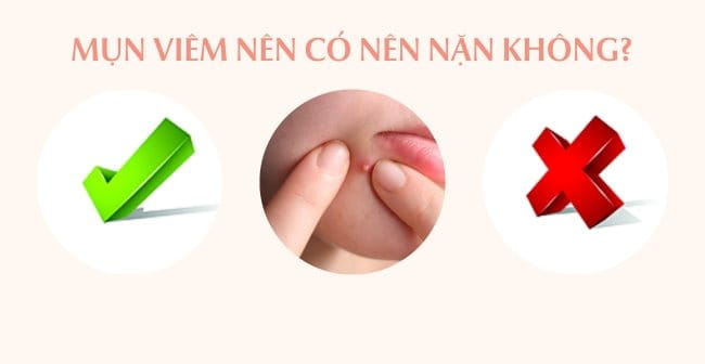 Mụn viêm có nên nặn không?