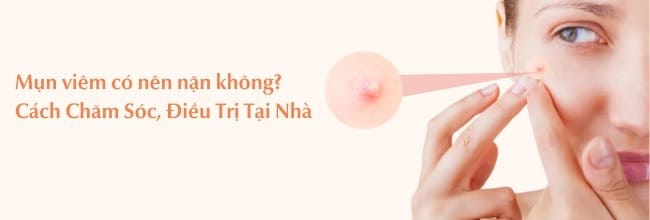 Mụn viêm có nên nặn không?