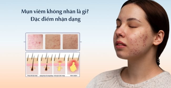 Mụn viêm đỏ không nhân là gì?