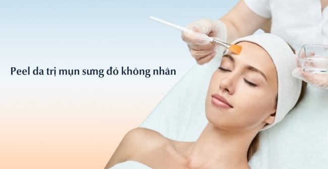 Peel da trị mụn viêm không nhân