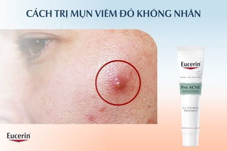 Cách trị mụn viêm đỏ không nhân