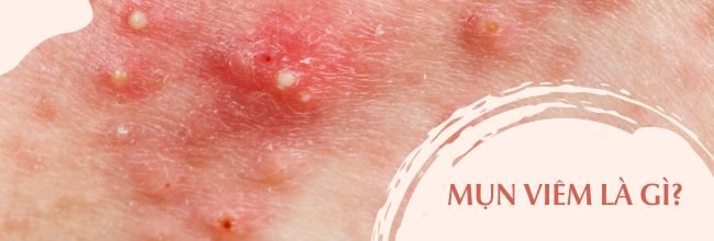 cách trị mụn viêm