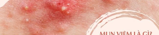 cách trị mụn viêm