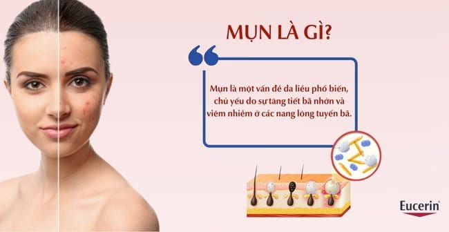 Mụn là gì?