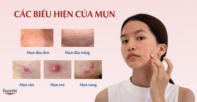 Các biểu hiệu của mụn