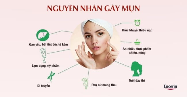 Nguyên nhân chính gây mụn