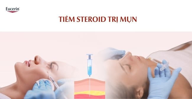 Tiêm Steroid trị mụn