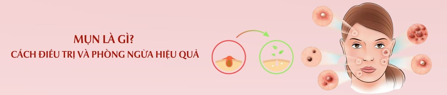 Mụn là gì?