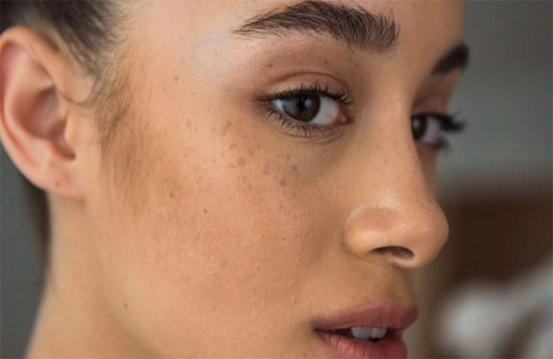 Nám chân sâu là gì? Nguyên nhân, dấu hiệu và cách điều trị hiệu quả