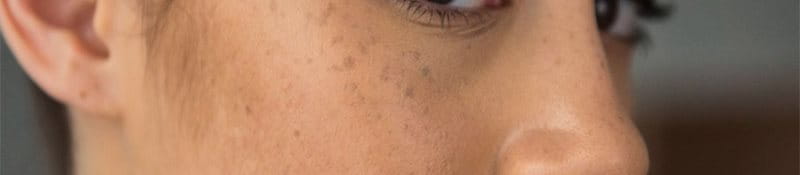 Nám chân sâu là gì? Nguyên nhân, dấu hiệu và cách điều trị hiệu quả