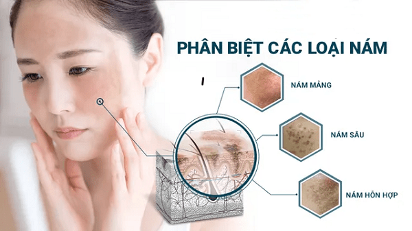 Nám Là Gì? Nguyên Nhân, Phân Loại Và Cách Điều Trị Hiệu Quả