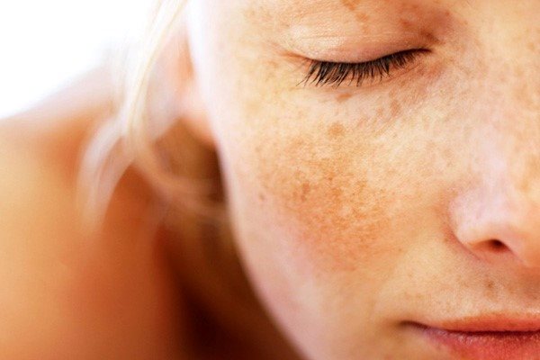 Triệu chứng của nám da là gì?