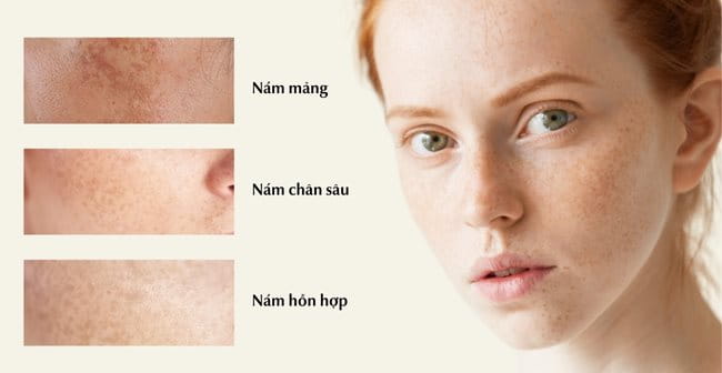 Phân loại nám da mặt vùng má phổ biến