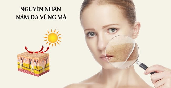 Nguyên nhân gây nám da mặt vùng má