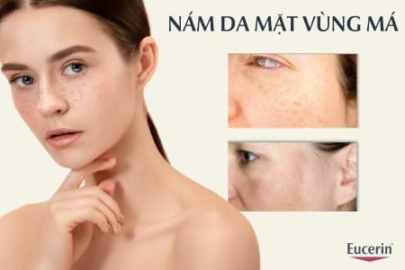 nám da mặt vùng má