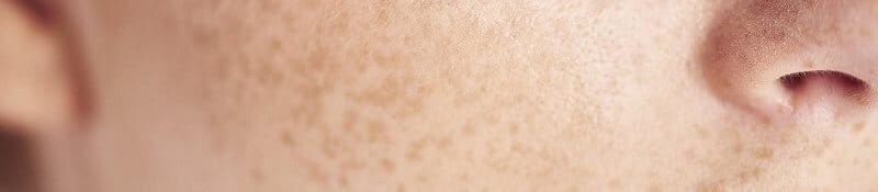 Nám hỗn hợp là gì