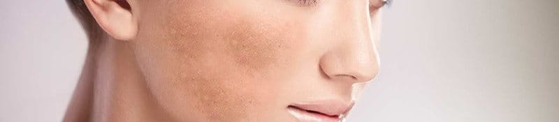 Nám mảng là gì? Nguyên nhân gây nám mảng?