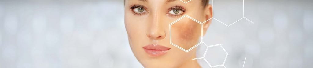 ngăn ngừa nám da