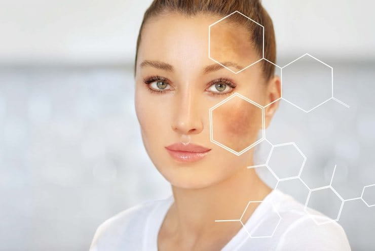 ngăn ngừa nám da