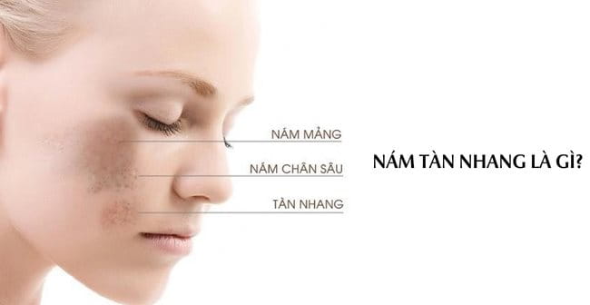 Nám tàn nhang ở da là gì?