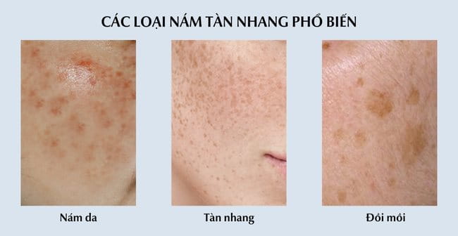 Các loại nám tàn nhang phổ biến