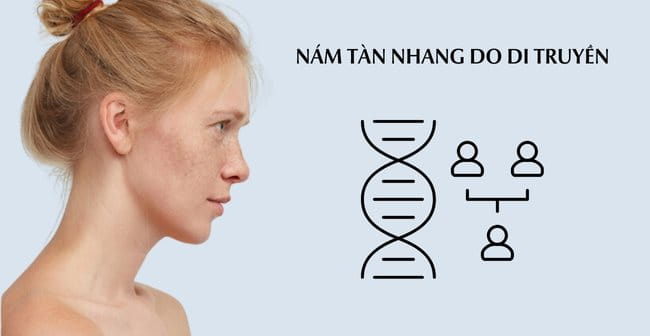 Da bị nám tàn nhang do di truyền