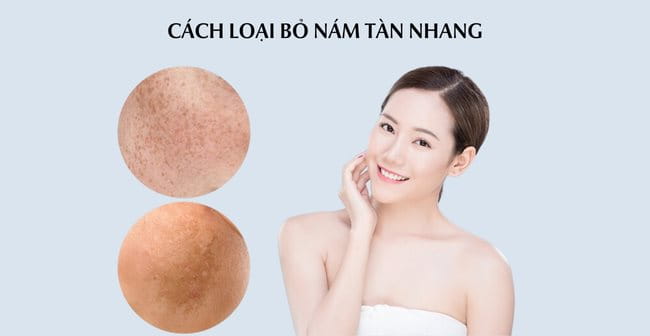 Cách loại bỏ nám tàn nhang tận gốc