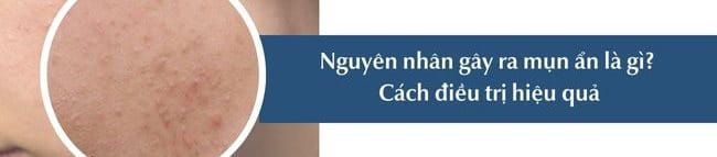 Nguyên nhân gây ra mụn ẩn cách điều trị hiệu quả