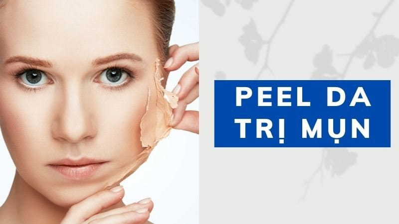 Peel da trị mụn là phương pháp gì?
