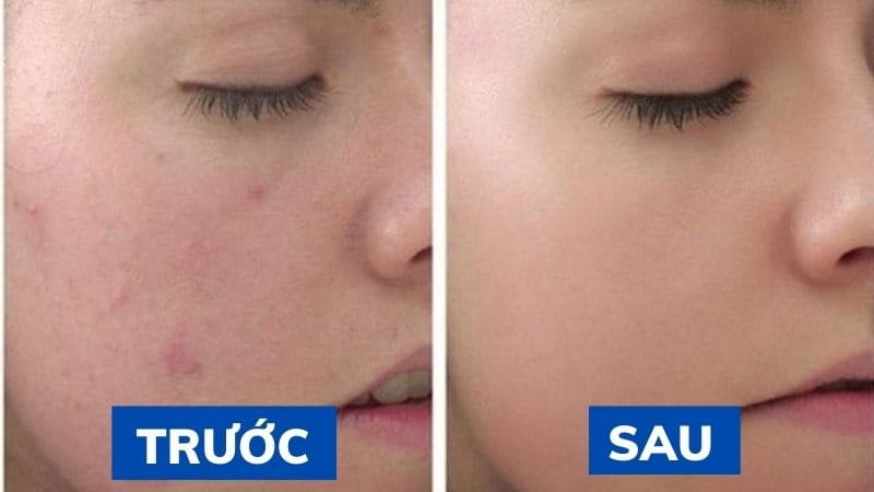 Tác dụng của peel da trị mụn