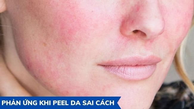 Phản ứng da khi peel da trị mụn không an toàn