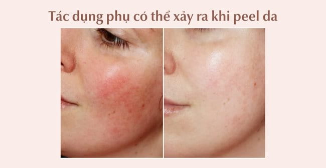 Tác dụng phụ có thể xảy ra khi thực hiện peel da